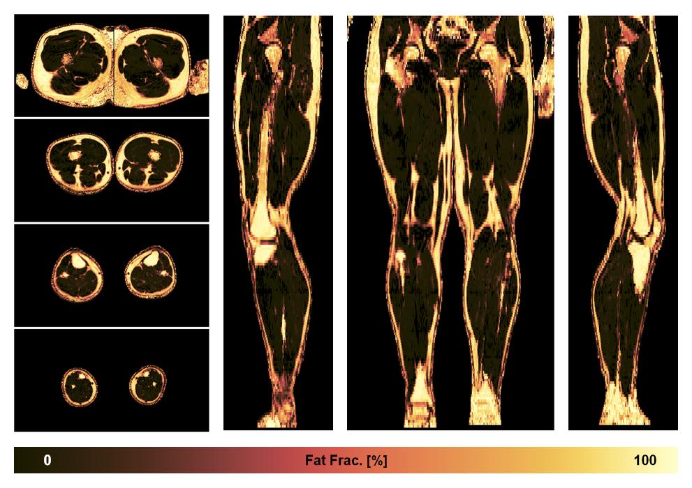 The fat fraction of the lower extremity obtained from the dixon reconstruction for muscle water fat quantification.